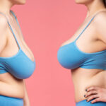 بهترین جراح فوق تخصص لیفت سینه با لیزر و نخ در تهران