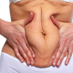 هزینه بهترین دکتر ابدومینوپلاستی تهران