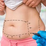 بهترین پزشک متخصص لیپوماتیک در تهران